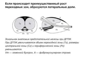 Рост латеральных долей предстательной железы