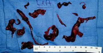 Почему во время месячных идут сгустки крови со слизью