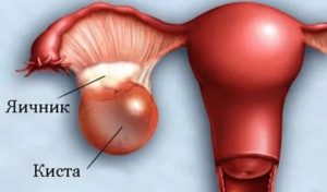 Могут ли быть прыщи при кисте яичника