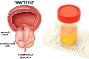 Кровотечение при простатите лечение