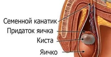 Что такое киста придатка правого яичка у мужчин