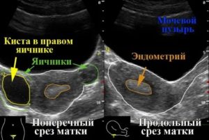 Что показывает узи при воспалении матки и яичников