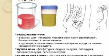 Может ли при цистите быть розовая моча