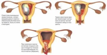 Когда могут начаться месячные после мифепристона