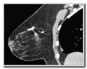 Что показывает кт легких при раке молочной железы