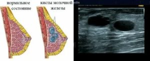 Чем опасен поликистоз молочной железы