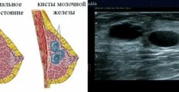 Чем опасен поликистоз молочной железы