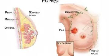 Что такое распад опухоли при раке молочной железы