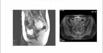 Как выглядит рак яичников на мрт