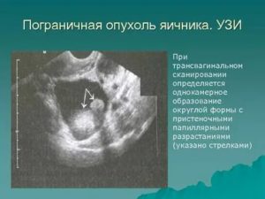 Может ли узи определить злокачественную опухоль яичника