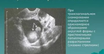 Может ли узи определить злокачественную опухоль яичника