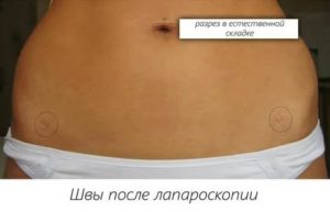 Почему не заживает шов после операции на яичнике