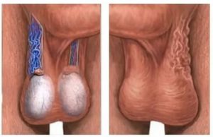 Опухоль между яичками и задним проходом у мужчин