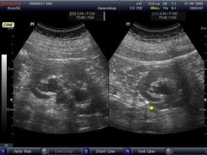 Узи мочеполовой системы. УЗИ мочевыводящей системы. УЗИ мочеточников. УЗИ выделительной системы.