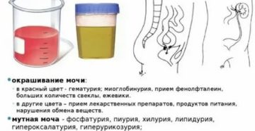 Какой цвет мочи при цистите у женщин