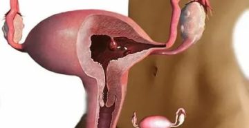 Когда нужно удалять полип до месячных или после месячных