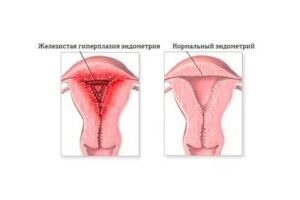 Как лечить гиперплазию эндометрия если нет месячных