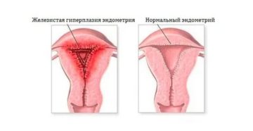 Как лечить гиперплазию эндометрия если нет месячных