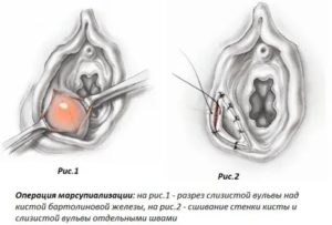 Что такое марсупиализация кисты бартолиновой железы отзывы