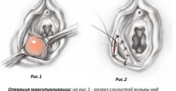 Что такое марсупиализация кисты бартолиновой железы отзывы