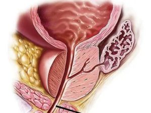 Suspicio tumor предстательной железы