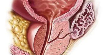 Suspicio tumor предстательной железы