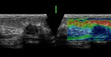 Узи молочной железы с эластографией отзывы