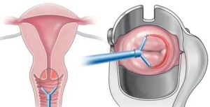 Какие операции бывают на шейке матки