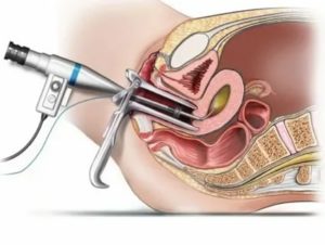 Диагностическое выскабливание полости матки от полипов или гистероскопия