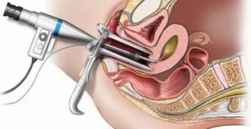 Диагностическое выскабливание полости матки от полипов или гистероскопия