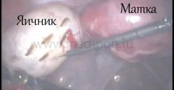 Могут ли быть месячные после операции по удалению яичников