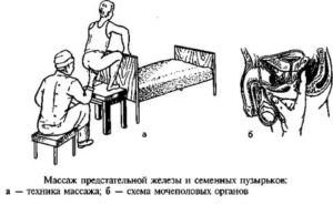 Обязательно ли делать клизму перед массажем простаты