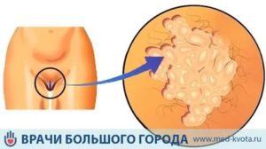 Химиотерапия при плоскоклеточном раке вульвы