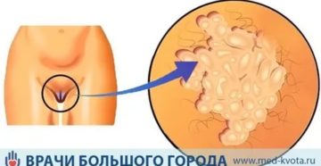 Химиотерапия при плоскоклеточном раке вульвы