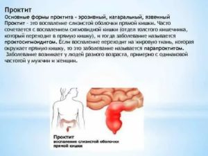 Чем лечить гонококковый проктит