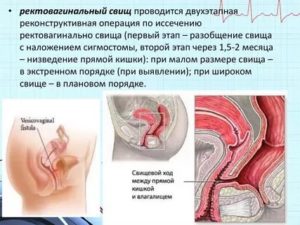 Кому делали операцию по ректовагинальному свищу