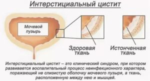 Как восстановить слизистую мочевого пузыря при хроническом цистите