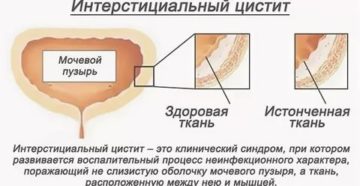 Как восстановить слизистую мочевого пузыря при хроническом цистите