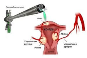 Как удаляют миому матки лазером