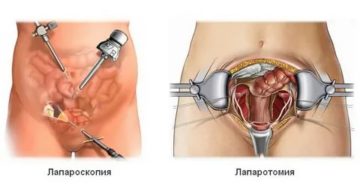 Как называется операция по удалению яичника и трубы