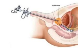 Как подготовиться к пункции предстательной железы