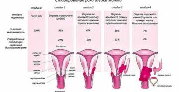 Могут ли быть метастазы при 2 стадии рака шейки матки