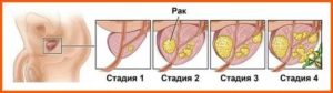 Можно ли есть чеснок при раке простаты