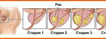Можно ли есть чеснок при раке простаты