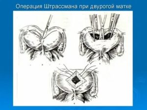 Как называется операция двурогой матки