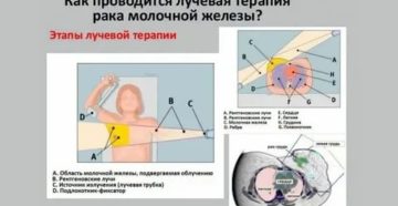 Что такое лечение облучением при раке молочной железы