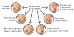 Как выглядит сосок втянутый при раке груди