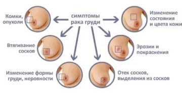 Как выглядит сосок втянутый при раке груди