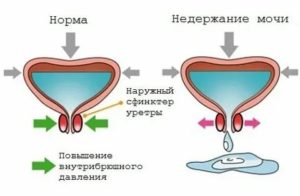 Недержание мочи у мужчин после тур простаты лечение