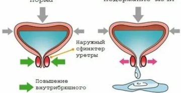 Недержание мочи у мужчин после тур простаты лечение